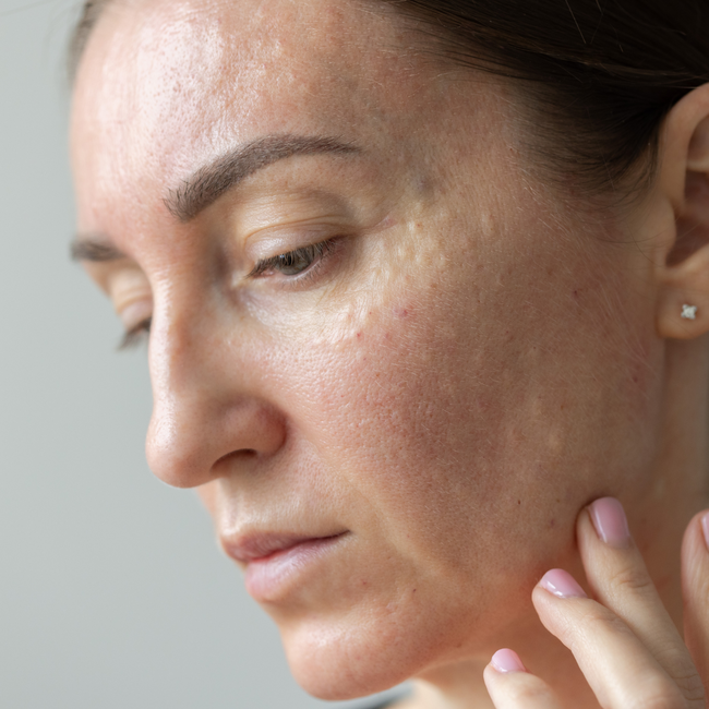 How to Calm Redness and Irritation When Cold Weather Wreaks Havoc on Your Skin