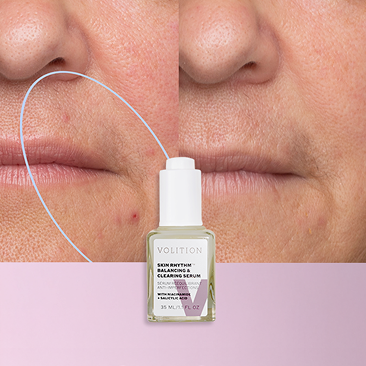 Hormonal Acne: Causes, Treatments & the Acids That Help